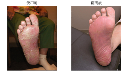 干癣患者对于Ultra Maco的使用