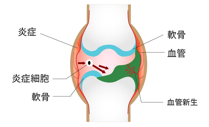 リウマチ関節炎
