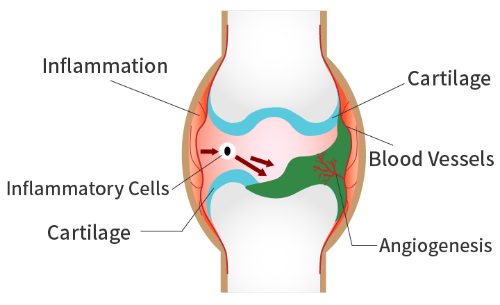 Rheumatoid arthritis