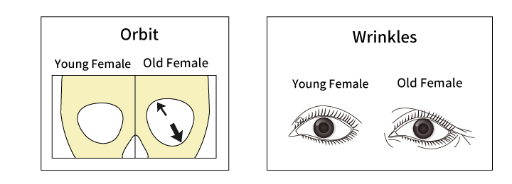 Relationship between the appearance of the face and osteoporosis of the skull